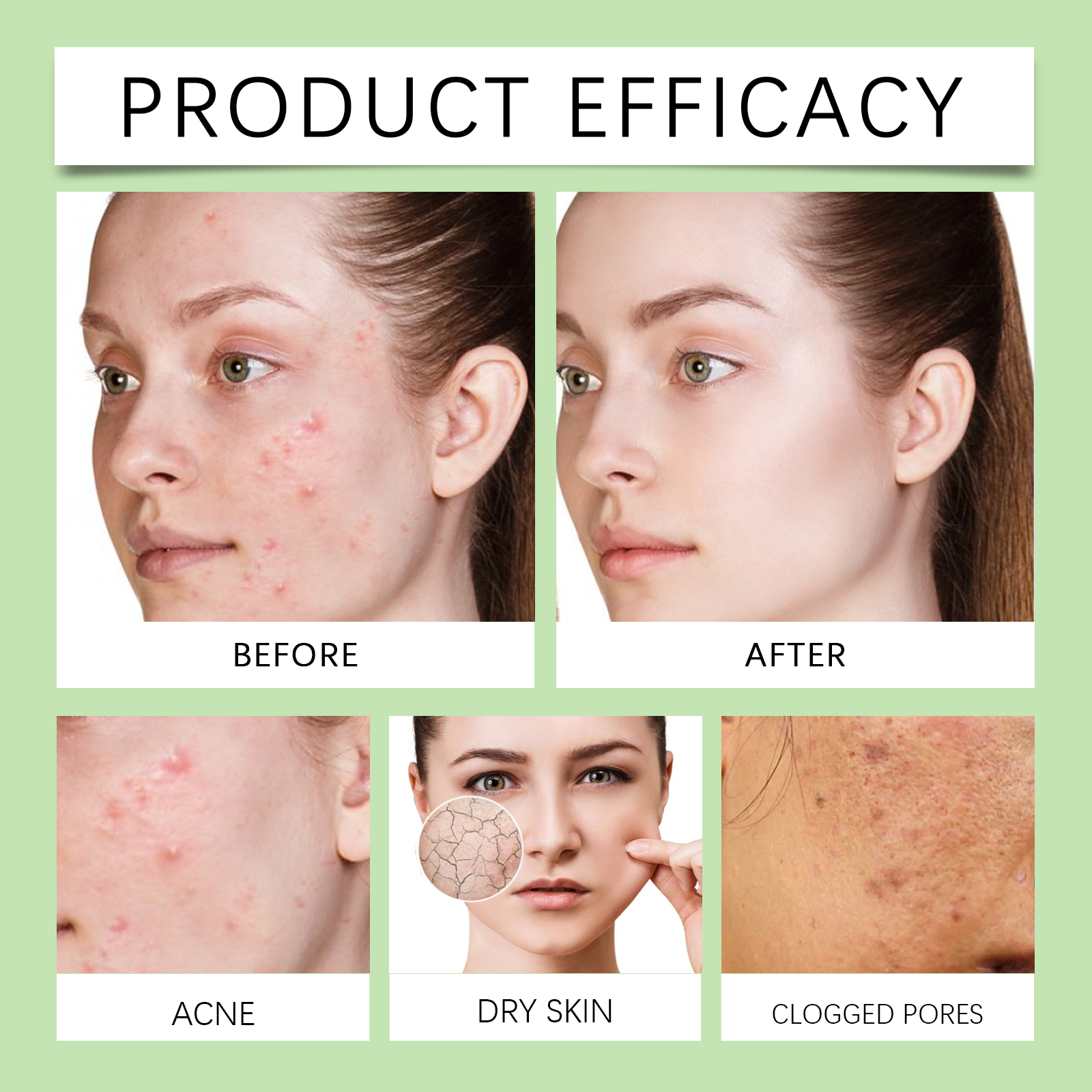 OUHOE Azelaic Acid Treatment Liquid Repair And Moisturize Acne Skin, Clear Pores And Moisturize Skin Care Essence_voghion.com