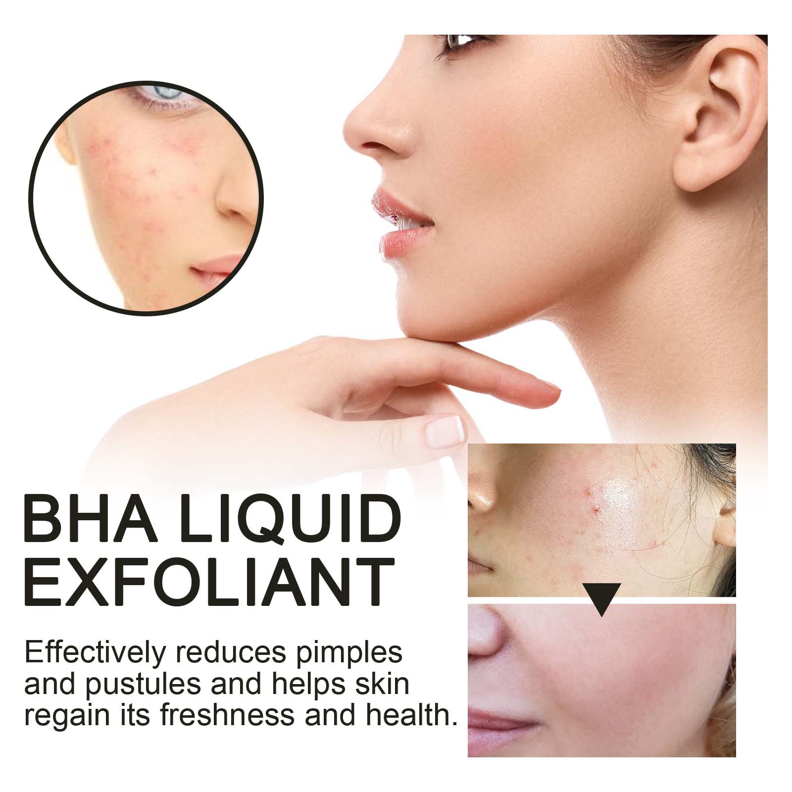 hoygi-bha-liquid-exfoliant-lightening-acne-seal-pore-tightening-and-moisturizing-skin-essence