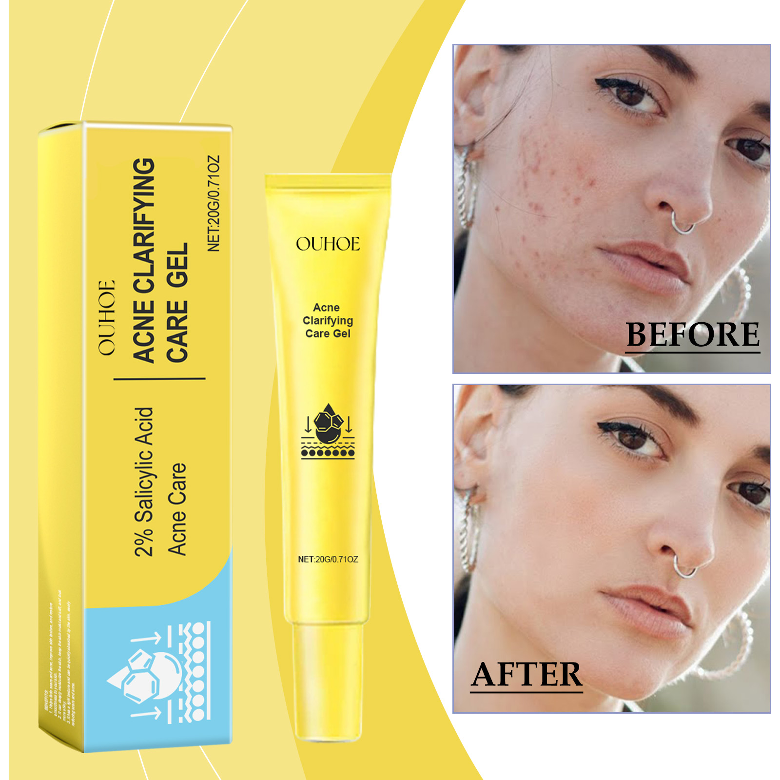 OUHOE Acne-Clearing Gel, Deep Cleansing Facial Skin Brightening And Concealer Treatment Gel For Acne Reduction_voghion.com